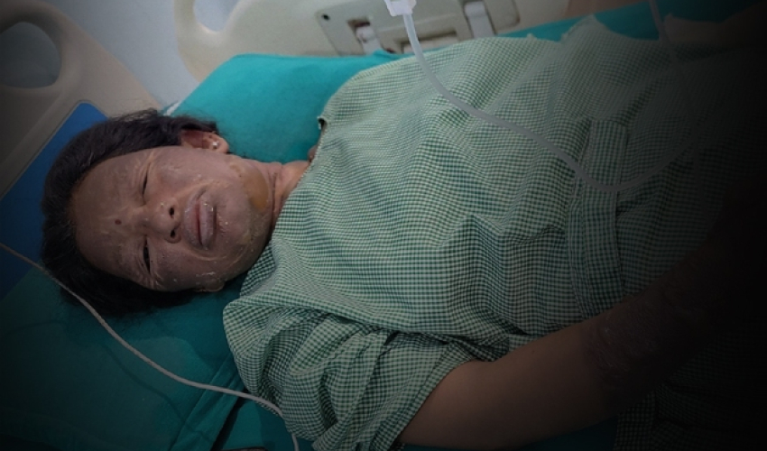 कैलालीमा ग्यास लिग भएर आगलागी, आमा–छोरा घाइते